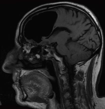 腦袋有洞意思|不是罵人的話──這個人的腦袋真的有「洞」